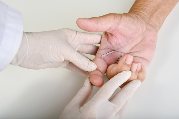 Chirurgie main à aix en provence : interventions et solutions